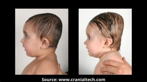 weird shaped head|newborn weird shaped head.